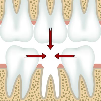 missing tooth causing other teeth to shift