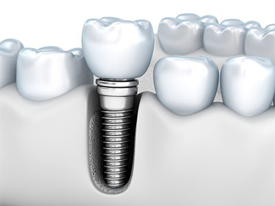 dental implant with dental crown restoration